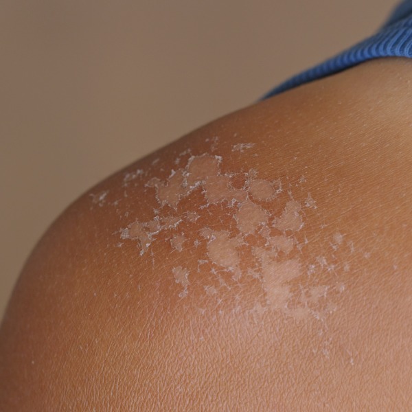 Top 5 des astuces pour arrêter de peler après un coup de soleil