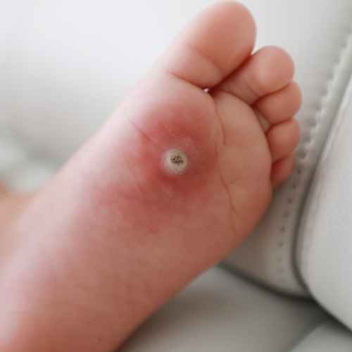 Oeil De Perdrix